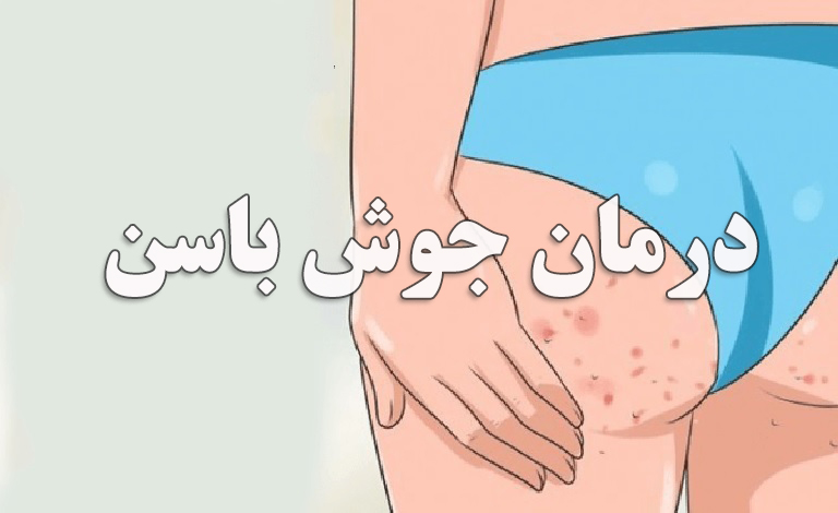 پماد برای جای جوش روی باسن