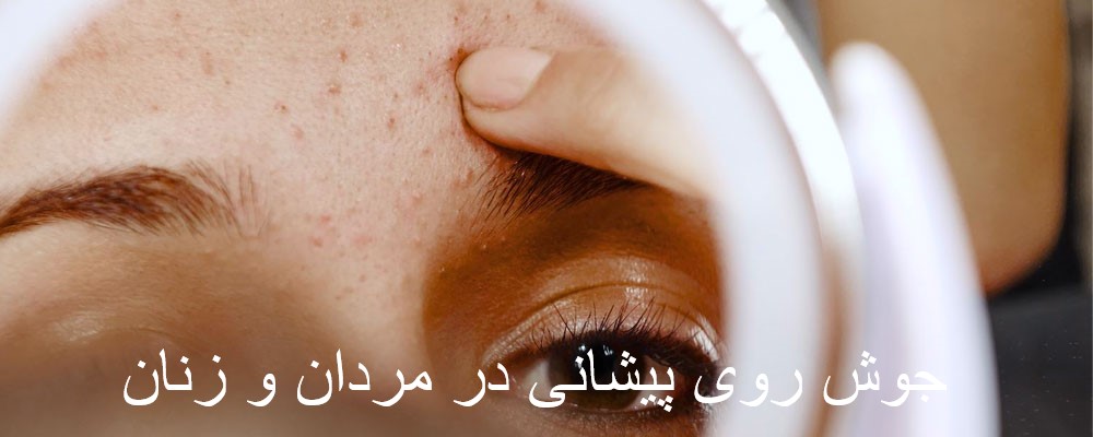 جوش روی پیشانی نشانه چیست؟ 