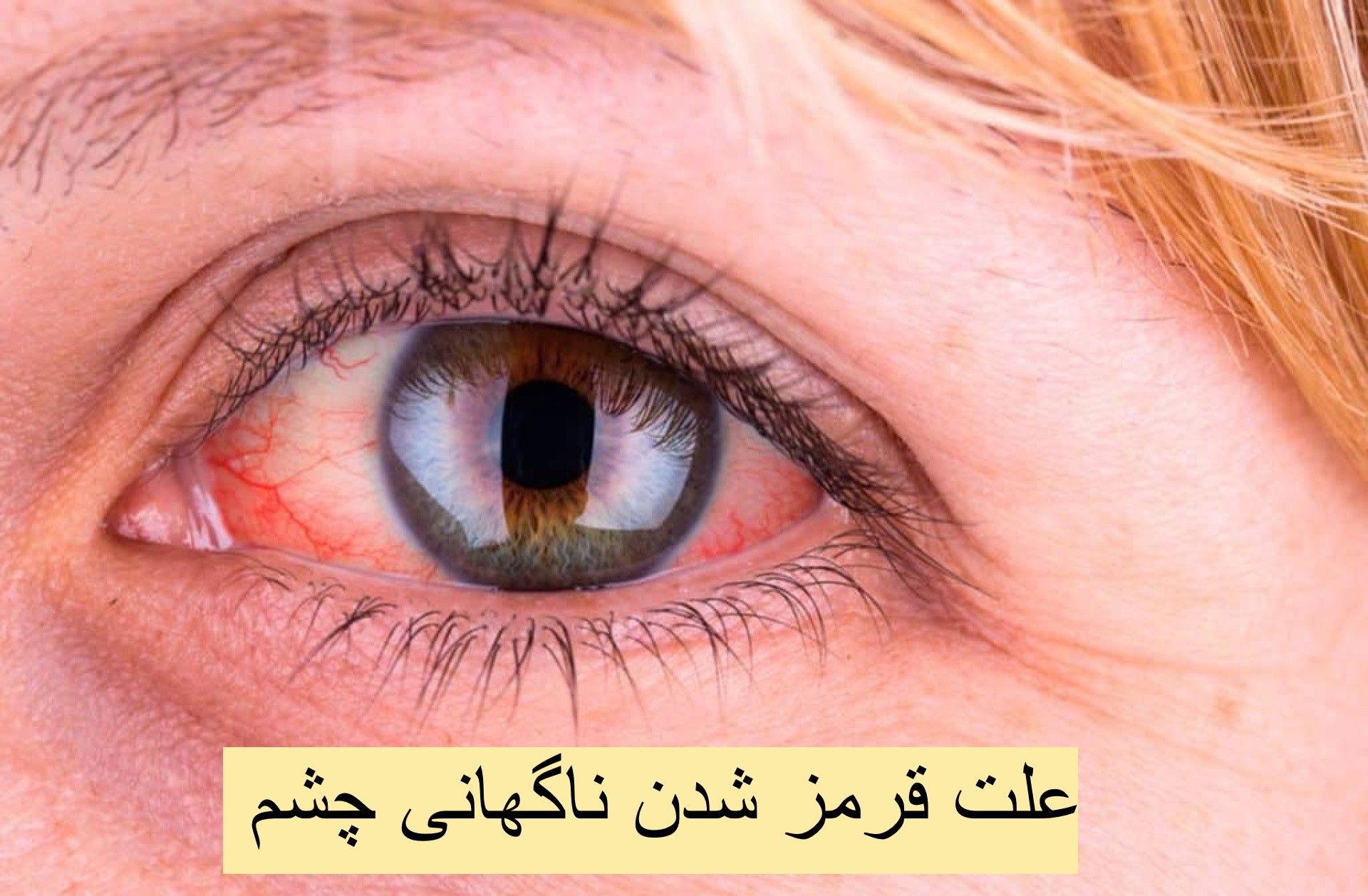 علت قرمز شدن ناگهانی چشم